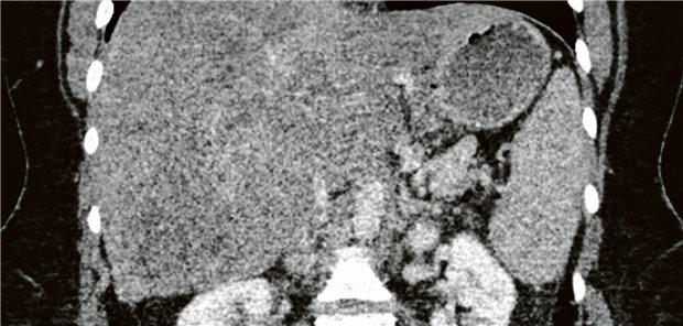 Welche seltene Differenzialdiagnose steckte hinter dem vermuteten Aszites? CT des Abdomens, portalvenöse Phase