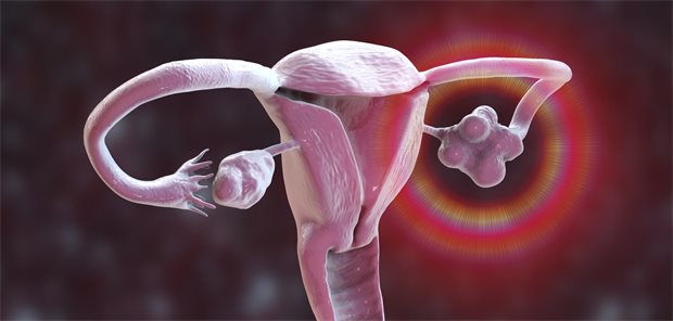 PMOS erhöht Herzinfarktrisiko junger Frauen deutlich Digitale Illustration der Gebärmutter mit polyzystischen Ovarien.