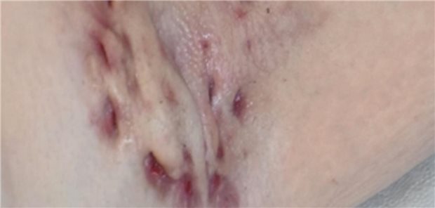 Die stille Last der Acne inversa Entzündliche, konfluierende Fistelgänge im Bereich der linken Axilla