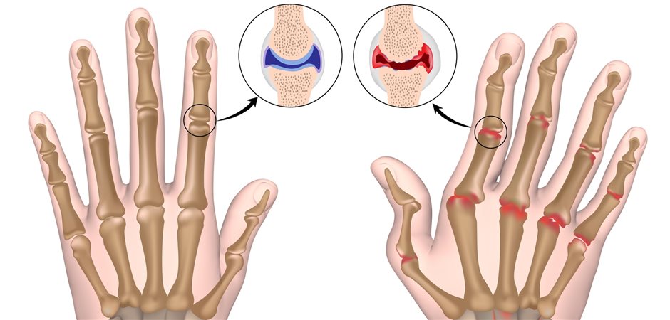 Neuer Wirkstoff gegen Rheumatoide Arthritis bewährt sich