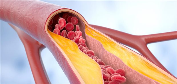 Empfehlungen aktualisiert: LDL-Cholesterin wann und wie senken? Ein Gefäß mit atherosklerotischen Plaques