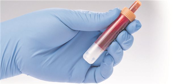 Wenn erhöhte Troponine täuschen und es kein Herzinfarkt ist Eine Blutprobe zur Bestimmung von vier kardiovakulären Schlüsselmarkern.