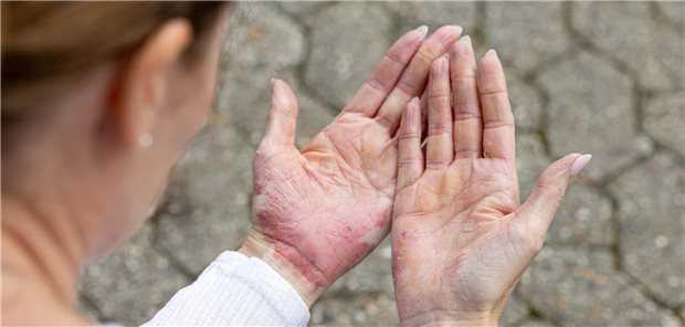 Chronisches Handekzem: Tipps für Diagnostik und Therapie Hauterkrankungen wie Ekzeme können sichtbare Beschwerden an den Händen verursachen.