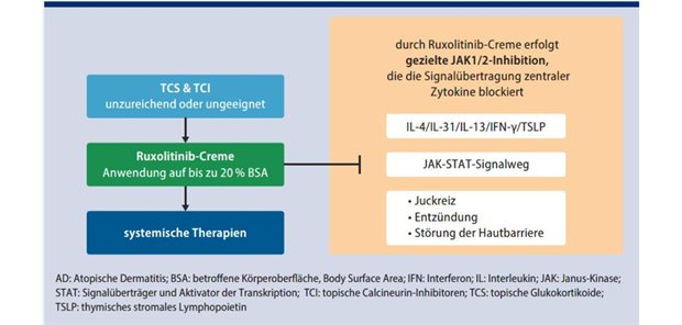 Topische steroidfreie Behandlungsoption bei atopischer Dermatitis Abb. 1: Anwendung von Ruxolitinib-Creme bei mittelschwerer AD