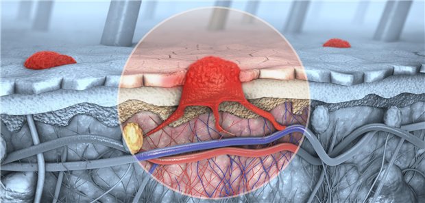 3D-Darstellung eines Schnitts durch die Haut mit einem Melanom, das Blut- und Lymphgefäße erreicht hat.