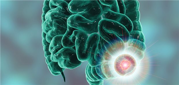 ASS gegen Darmkrebs: Risiken überwiegen einen ungeklärten Nutzen Illustration einer Darmkrebs-Läsion, die rot im Dickdarm aufleuchtet.