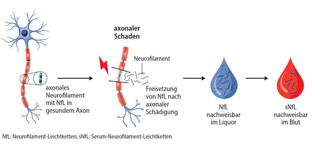 Abb. 1: Freisetzung von Neurofilamenten aus geschädigtem Axon