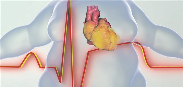 Adipositas und Vorhofflimmern: Besteht ein direkter Zusammenhang? Grafik eines übergewichtigen Menschen und einem EKG