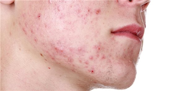 Welche Ernährung bei Akne ratsam ist Nahaufnahme der rechten Wange eines Patienten mit Acne vulgaris.