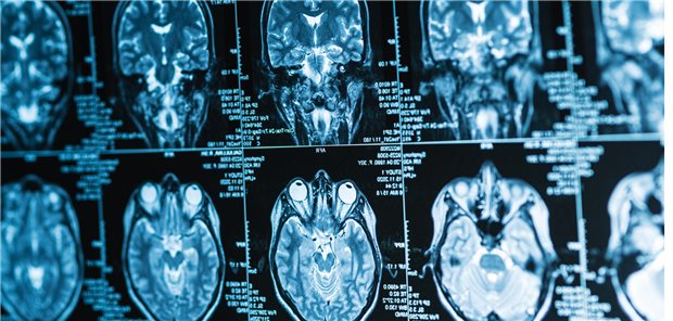 Algorithmen lassen sich in einer Weise trainieren, dass sie in MRT-Aufnahmen Gehirnmuster erkennen, die kein Neuroradiologe sehen kann. Solche Muster können nicht nur das biologische Alter des Gehirns ermitteln und damit das Risiko für neurologische Krankheiten bei Menschen im mittleren Lebensalter abschätzen, was für die Selektion von Teilnehmenden für klinische Studien relevant sein kann.
