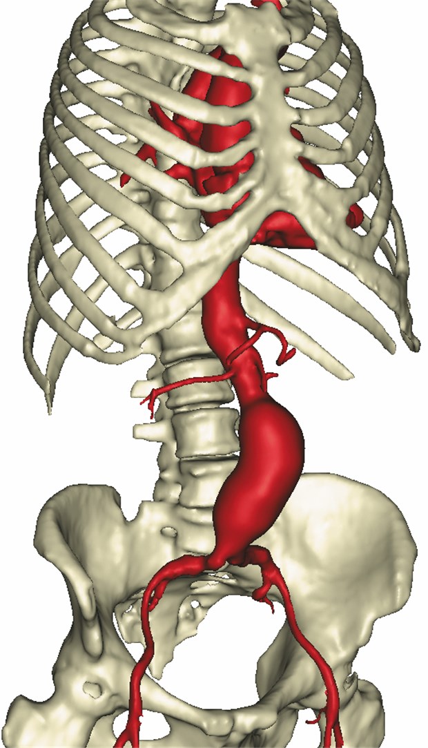 Aneurysma Der Bauchaorta Ist Ein Leiser Killer