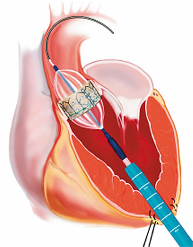 Neue Herzklappe Per Katheter Rettet Patienten Das Leben