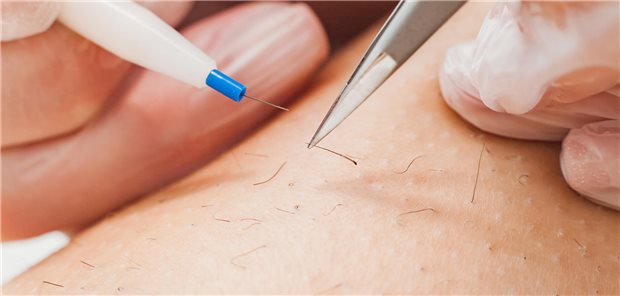 Urteil: Beihilfe muss bei Transsexuellen nicht für Barthaarentfernung zahlen Ein Haarentfernung im Close-up.