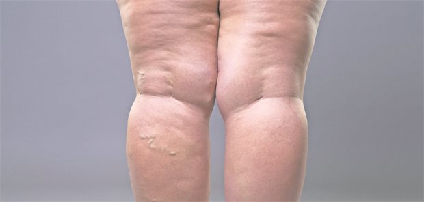 Liposuktion verbessert Symptome in allen Lipödem-Stadien Beine einer Frau von dorsal mit Lipödem