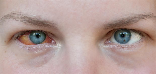 Kontaktlinsen und rotes Auge – an mikrobielle Keratitis denken! Ein Mann mit einem roten Auge.