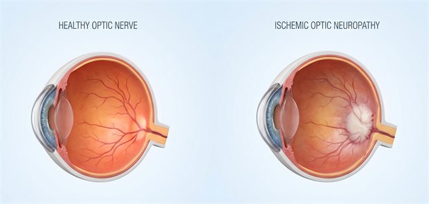 Semaglutid und NAION: Absolutes Risiko bleibt gering Schematisches Bild eines normalen Optikusnerven und eines Optikusnerven bei Neuropathie