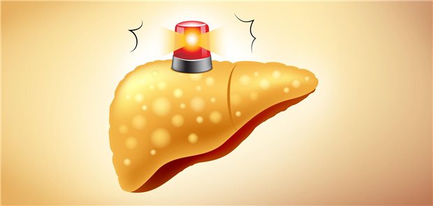 Bei einer Fettlebererkrankung steigt die Konzentration der Gallensäuren an, welche sich wiederum negativ aufs Herz auswirken. Eine Therapie der Fettleber könne so das Risiko für kardiale Folgen senken, heißt es beim 60. EASD-Kongress in Madrid. (Symbolbild)