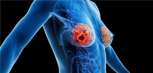 Frühes Mammakarzinom: So optimieren Sie die Therapie Brustkrebs Symbolbild