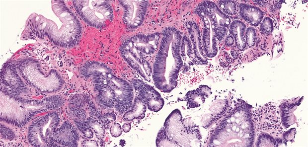 „Klug entscheiden“: Einmalige Magenspiegelung soll Barrett-Ösophagus erkennen Histologisches Präparat eines Barrett-Ösophagus