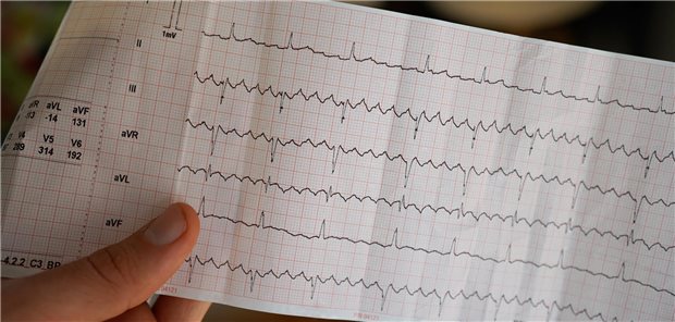 Die Hand eines Arztes hält ein Elektrokardiogramm eines Patienten mit Vorhofflimmern.