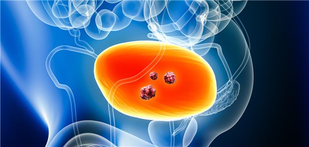 Beim Kongress der Deutschen Gesellschaft für Urologie (DGU) in Leipzig wurde über die Verbesserung der Prognose bei muskelinvasivem, nicht metastasierten sowie metastasiertem Urothelkarzinom berichtet.