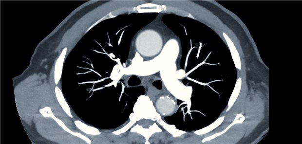 Beim Kongress der European Respiratory Society (ERS) wurde über die korrekte Behandlungsstrategie bei Patienten mit schwerer Lungenembolie diskutiert.