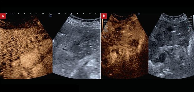 Image 2: CM ultrasound; a) (Iso-)contrast in the arterial phase. b) Hypocontrast in the late phase