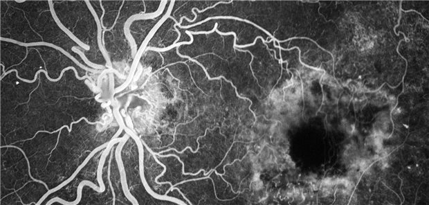Aflibercept 8 mg bei nAMD, DMÖ und jetzt auch RVV Aflibercept 8 mg bei nAMD, DMÖ und jetzt auch RVV