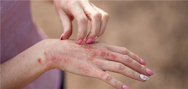 Bifonazol: Antimykotikum mit antientzündlicher Wirkung Bifonazol: Antimykotikum mit antientzündlicher Wirkung