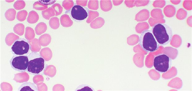 Acalabrutinib: TTNT-Update der AMPLIFY-Studie und RWE-Daten Acalabrutinib: TTNT-Update der AMPLIFY-Studie und RWE-Daten