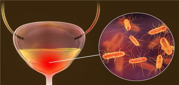 Therapie bei unkomplizierter Zystitis Therapie bei unkomplizierter Zystitis