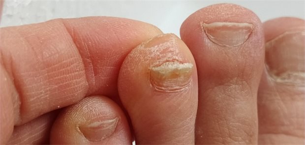 Thailandpilz, Tierkontakt & Nagelpilz Thailandpilz, Tierkontakt & Nagelpilz