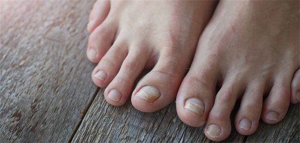 StiWa empfiehlt wenige Nagelpilz-Mittel – Canesten® Extra dabei StiWa empfiehlt wenige Nagelpilz-Mittel – Canesten® Extra dabei