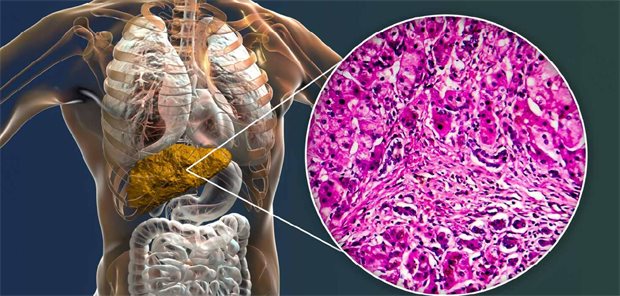 Primär Biliäre Cholangitis: therapeutisches Potenzial der PPAR-Aktivierung Primär Biliäre Cholangitis: therapeutisches Potenzial der PPAR-Aktivierung
