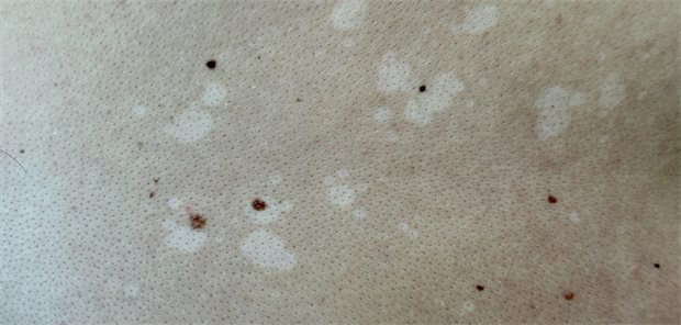 Pityriasis versicolor sicher erkennen und gezielt behandeln Pityriasis versicolor