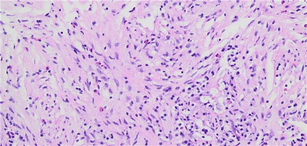 Figure 3, EP of the liver: granulomatous inflammatory reaction of epithelioid cells with extensive necrosis, liver tissue or infiltrates of a malignant tumor cannot be detected