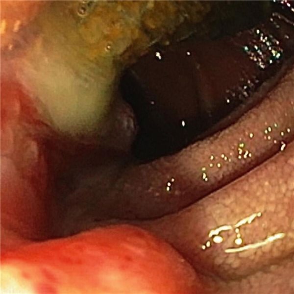 Image 4, endoscopy: suspected infiltration (6 to 9 hours) of the duodenum