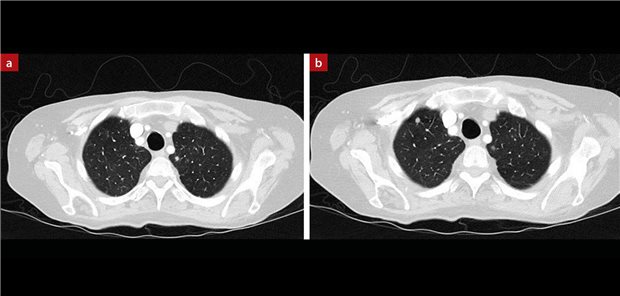 Image 5, CT chest: small granulomas in the upper left and right field