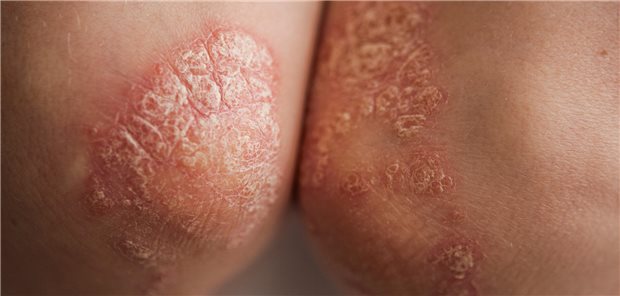 Psoriasis-Patienten besser gleich mit Biologika behandeln? Große rote, entzündete, schuppige Hautveränderungen aufgrund von Psoriasis an den Ellenbogen.