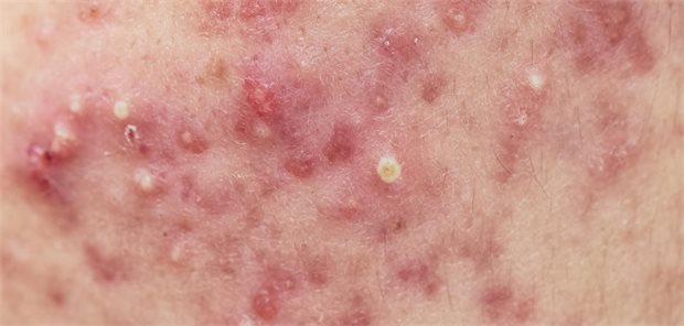 Aktualisierte Leitlinie setzt neuen Therapiestandard bei Akne Ein Close-Up-Bild einer Haut mit Akne-Pickeln.