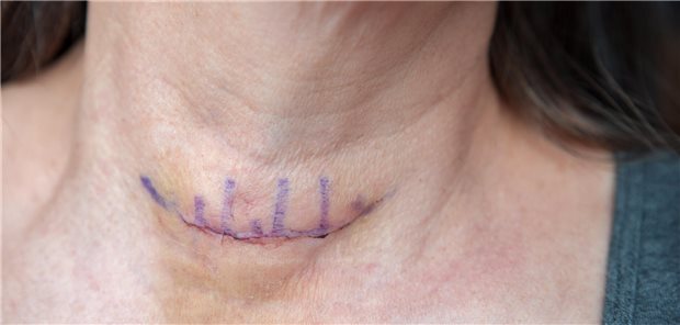 Hyperparathyreoidismus: Operation kann vor Diabetes schützen Detailaufnahme einer frisch genähte Operationswunde nach einer Schilddrüsenoperation.