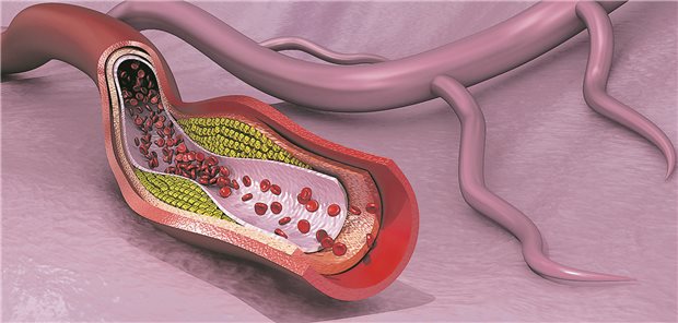 Risikofaktoren, Lp(a), Vitamine – Neues aus der Dyslipidämie-Leitlinie Cholesterin-Plaque