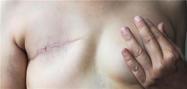 Chronische postoperative Schmerzen: Wer ein besonders hohes Risiko hat Frau nach Mastektomie
