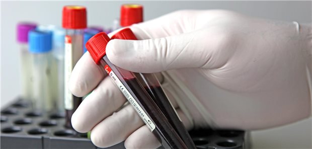Ursachenfindung der Leukozytose: Reaktiv, Infektion oder Leukämie? Eine Hand in Gummhandschuhen hält zwei Röhrchen mit Blut in der Hand.