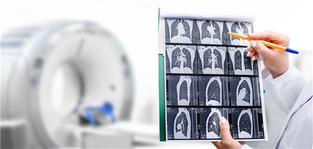 Lungenkrebs-Screening: Von Zielen, Chancen und technischen Fortschritten CT-Aufnahmen des Thorax