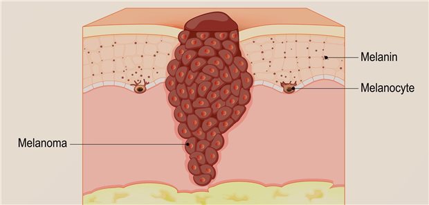 Schematische Darstellung eines Malignen Melanoms
