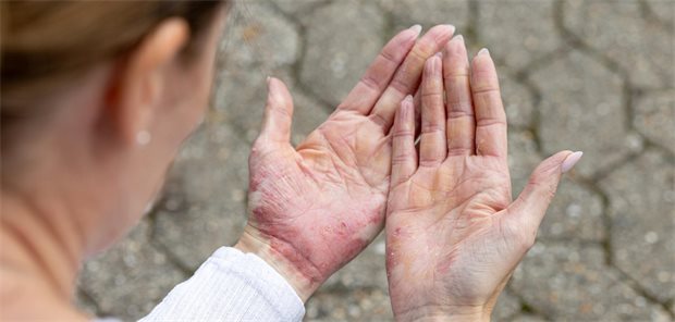 Neue Behandlungsoptionen beim chronischen Handekzem Eine Frau schaut sich ihre Handinnenflächen an, die vom Ekzem gerötet sind.