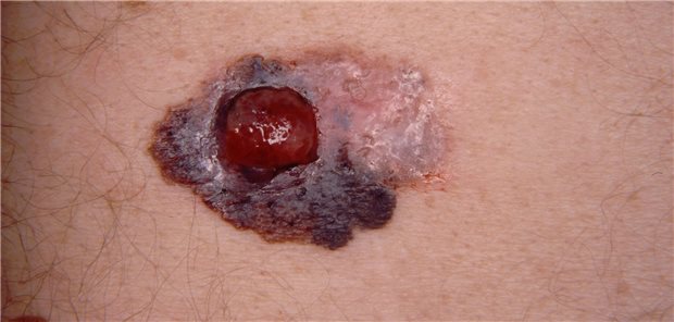 Malignes Melanom: Impfen als Booster für die Checkpointblockade Ein schwarzer Hautkrebs.