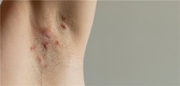 Wie Acne inversa erkannt und behandelt wird Ein Patient, bei dem Hidradenitis suppurativa unter den Achseln diagnostiziert wurde, mit sichtbaren roten, schmerzhaften Fisteln.