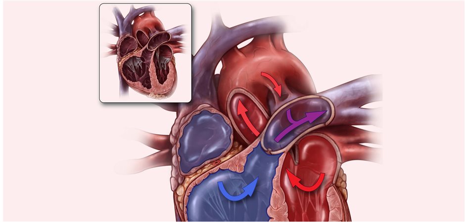 Besser Kein Ibuprofen Bei Offenem Ductus Arteriosus